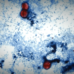 What’s cyclosporiasis? Signs, complete instances, map & newest – NBC New York