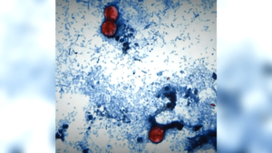 0_04-4P-VO-CYCLOSPORIASIS.mp4.png